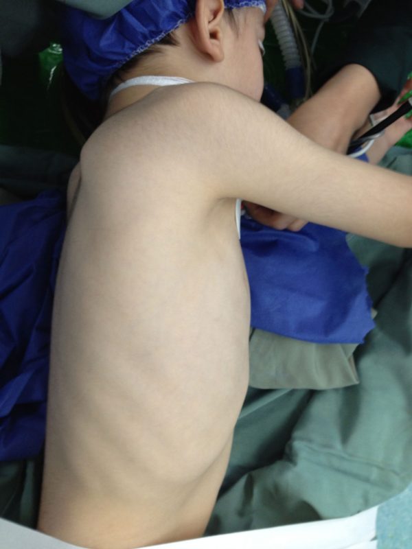 کودک دارای کیست هیداتید