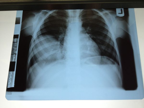 کیست هیداتید در عکس