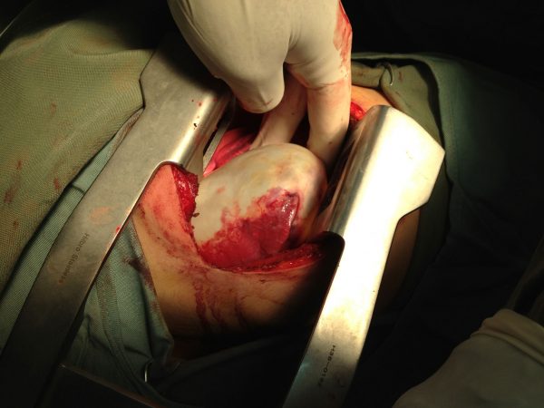 خروج کیست هیداتید